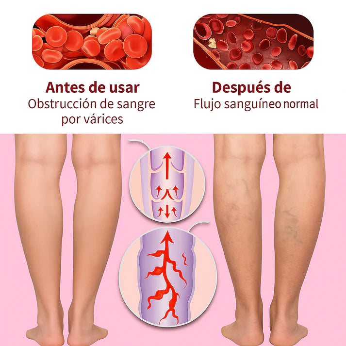 BioVarix - Tu aliado natural contra las várices